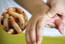 Las autoridades de salud de Hidalgo confirmaron que ya son siete los casos de infestación por gusano barrenador en personas