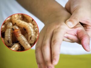 Las autoridades de salud de Hidalgo confirmaron que ya son siete los casos de infestación por gusano barrenador en personas